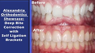 Alexandria Orthodontics Showcase Deep overbite correction with Self Ligation Braces [upl. by Yerfoeg]