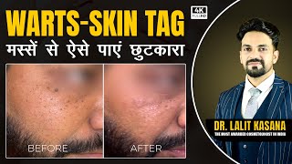 Warts Skin Tag Removal Treatment by Dr Lalit Kasanas [upl. by Maxia]