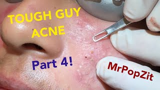 Tough Guy Acne part 4Acne extractionsMake an appointment with me details in description Lets go [upl. by Ornie184]