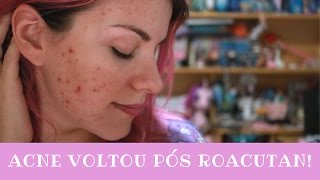 Após Roacutan Acne Voltou 💔😿 Falando Sobre Relapso 5 Anos Após Isotretinoína  Mari Santarem [upl. by Jenness]