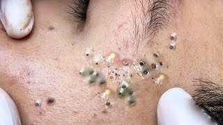 The Right Way to Remove Blackheads  What You Should Know 559 [upl. by Edric]