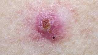 Basal Cell Carcinoma Symptoms Causes and Treatment  First Aid  Made Easy [upl. by Ahseikan55]