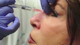 Nonsurgical Rhinoplasty [upl. by Alf]