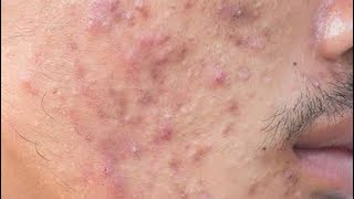 Acne Treatment  Blackhead  Blackhead Removal on forehead  Remove Blackhead [upl. by Grubb]