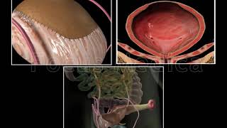 Surgical treatment of OAB  Animated Atlas of BPH and OAB [upl. by Koziara853]