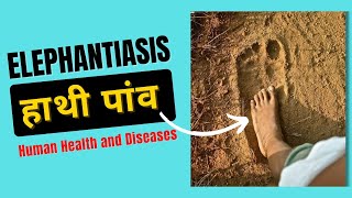 Elephantiasis Symptoms  Filariasis Class 12  Human Health and Diseases [upl. by Stanford]