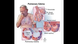 Pulmonary EdemaCardiogenic Pulmonary edemaNonCardiogenic Pulmonary edemaRespitory Therapist [upl. by Bergeron]