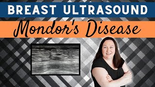 Breast Ultrasound Pathology Gallery  Mondors Disease [upl. by Lasonde]