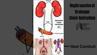 Nephroureteral Drainage Stent Animation 1 medical animation 3d short [upl. by Einaj]