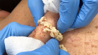 Stubborn Sac and Cyst Removal  CONTOUR DERMATOLOGY [upl. by Chute]