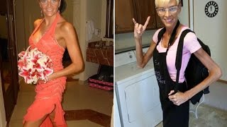 Ex Model Lisa Brown Starving To Death Due To Rare Disease [upl. by Louis445]