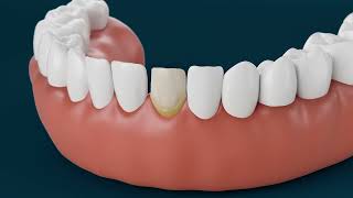 What are porcelain veneers  Aspen Dental [upl. by Aivatnuahs886]