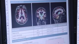 Introduction to CorTechs Labs and NeuroQuant [upl. by Strader]