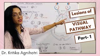 Visual Pathway  Lesions  Part 1 [upl. by Annemarie]