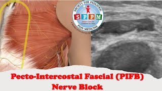 PectoIntercostal Fascial PIFB Nerve Block [upl. by Nomaj]