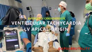 Emergency synchronized cardioversion in ventricular tachycardia VT LV apical origin [upl. by Levon691]