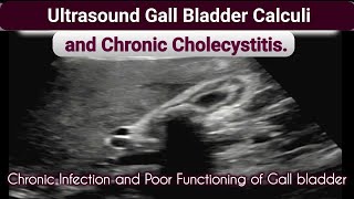 Ultrasound Gall bladder Chronic Cholecystitis and Calculi [upl. by Lodnar]