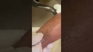 IV cannula insertiondoctertrendingshortvideoviralvideo [upl. by Gnilyarg]