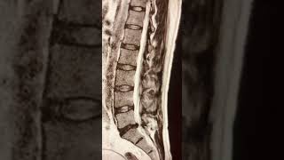 L5S1 Disc herniation radiology shortsviral shortvideo short medical [upl. by Benjamen271]