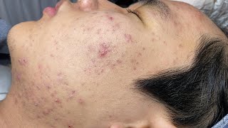 ACNE TREATMENT VU QUYNH MI  Blackheads Of Tweens 2024 EX [upl. by Aeel815]