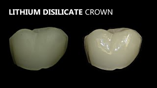 Porcelain Veneer Crown and Bridge Polishing [upl. by Adnilreh]