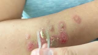 Petroleum Jelly  Tweezers vs Barnacles Psoriasis [upl. by Estey]