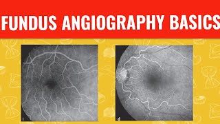 FFA course  FUNDUS FLUORESCEIN ANGIOGRAPHY [upl. by Ri204]