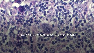 Classic Hodgkin lymphoma [upl. by Onaicilef]