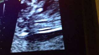 12 Week Ultrasound  Its a BOY [upl. by Judye]