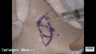 Orbital Ball Implant Exposure Dermis Patch Graft [upl. by Nidnal57]