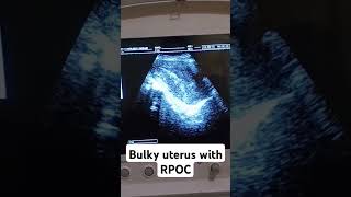 Bulky uterus with RPOCsharevidio shortyoutubevideo [upl. by Leahciam]