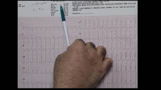 Left Posterior fascicular VT [upl. by Trevar]