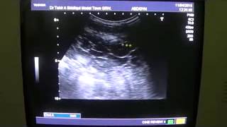 SEPTATED ASCITES by ultrasound study [upl. by Yllen]