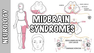 Midbrain Syndromes  Weber’s Syndrome Benedikt’s Syndrome and Parinaud Syndrome [upl. by Past]