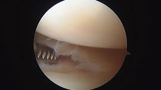 L knee partial bilateral menisectomy and chondroplasty 21020 WM [upl. by Benenson522]