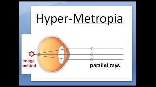 Ophthalmology 044 b HyperMetropia HyperOpia long sightedness Shot silk appearance pseudopapillitis [upl. by Dduj23]