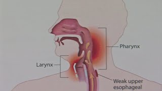 Good Question What Causes Laryngitis [upl. by Anyg]