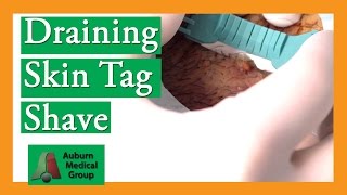 Shave Biopsy of Skin Tag with Sebaceous Cyst  Auburn Medical Group [upl. by Udela]