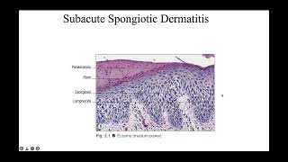 Spongiotic reaction patterns [upl. by Primo]