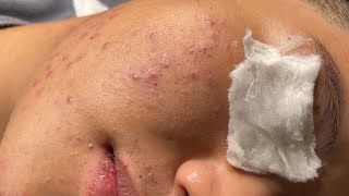 Acne Treatment Bo Nguyễn Spa  Blackheads On Tween Face 2024FULL [upl. by Essila59]