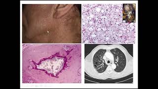 Renal Tumors Case 5 [upl. by Bartram936]