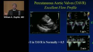 Prosthetic Valve Assessment William A Zoghbi MD April 29 2016 [upl. by Fasano]