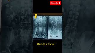 Intravenous urography IVU showing hydronephrosis amp renal calculihydronephrosis renalcalculi [upl. by Slohcin]