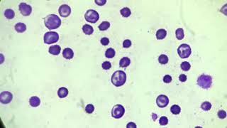 Anaemic changes  anisocytosis  microcytosis [upl. by Allerim652]