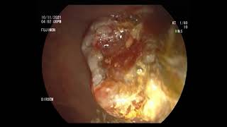 choledocholithiasis with cholangitis stone extraction [upl. by Raoul]