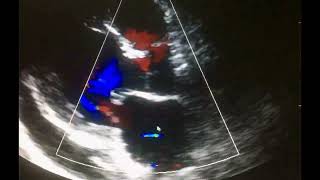 Ecocardiograma Complicaciones del Infarto al miocardio [upl. by Ahsenor]