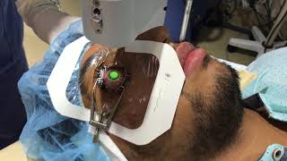 Collagen Cross Linking For keratoconus [upl. by Viviane]