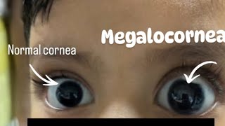 Normal corneal Diameter VS Megalocorneal Diameter  Optometry Solutions [upl. by Anitteb35]