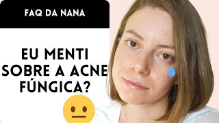 Acne Fúngica NÃO EXISTE A verdade sobre a MALASSEZIA [upl. by Faxun]