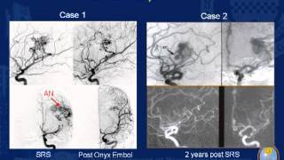 Stereotactic Radiosurgery for Arteriovenous Malformations with Hemorrhage History [upl. by Enileoj]